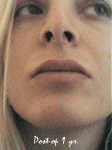 postop1yr.GIF (61755 bytes)